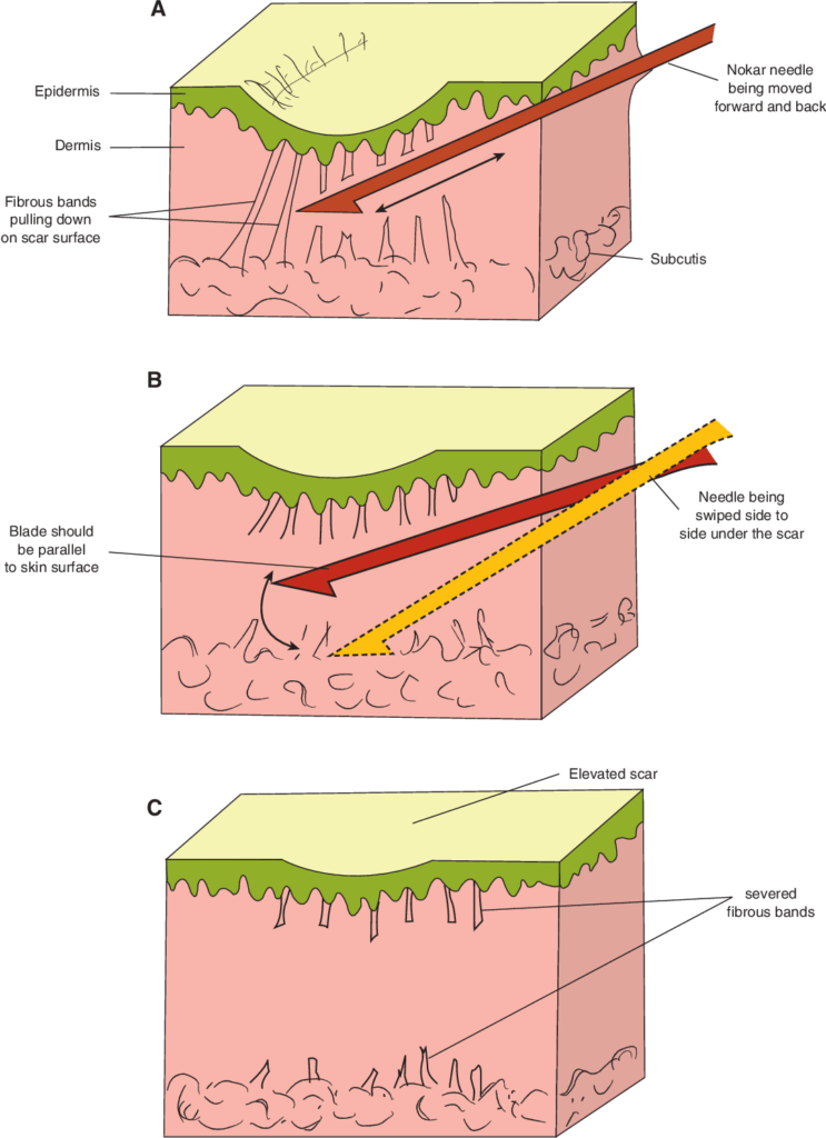 Subcision acne scars Read more about the treatment