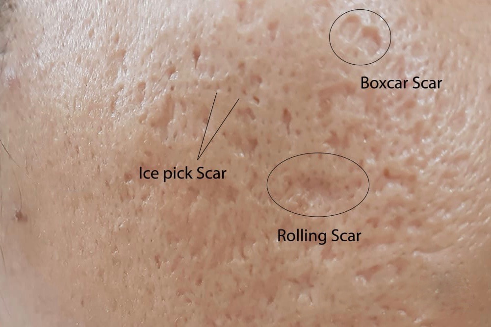 rolling acne scars
