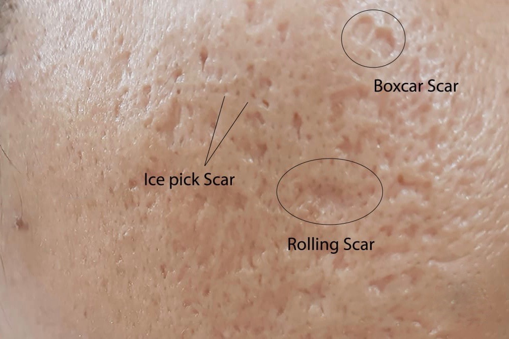 Fractional co2 laser treatment for acne scars