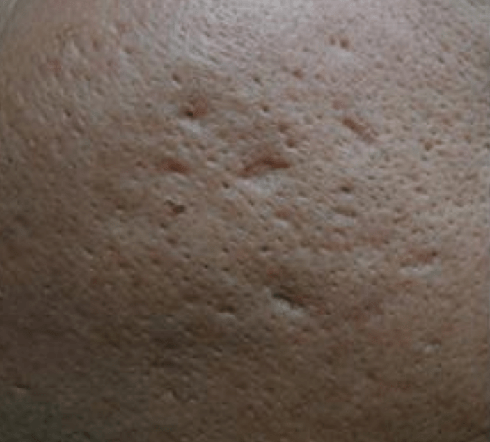 how to get rid of boxcar acne scars