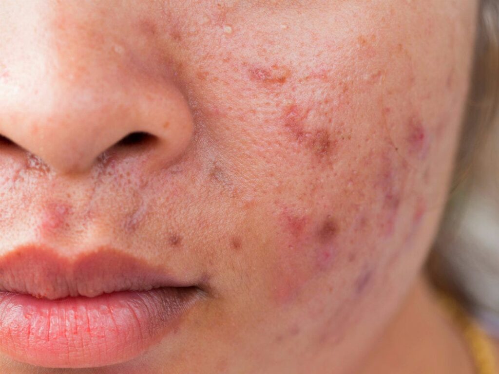 Acne Scars Before And After Accutane