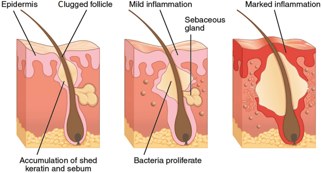 isotretinoin for acne (Accutane & Roaccutane)