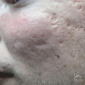acne scars - treatment - dr Knap