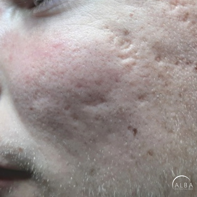 acne scars before and after accutane