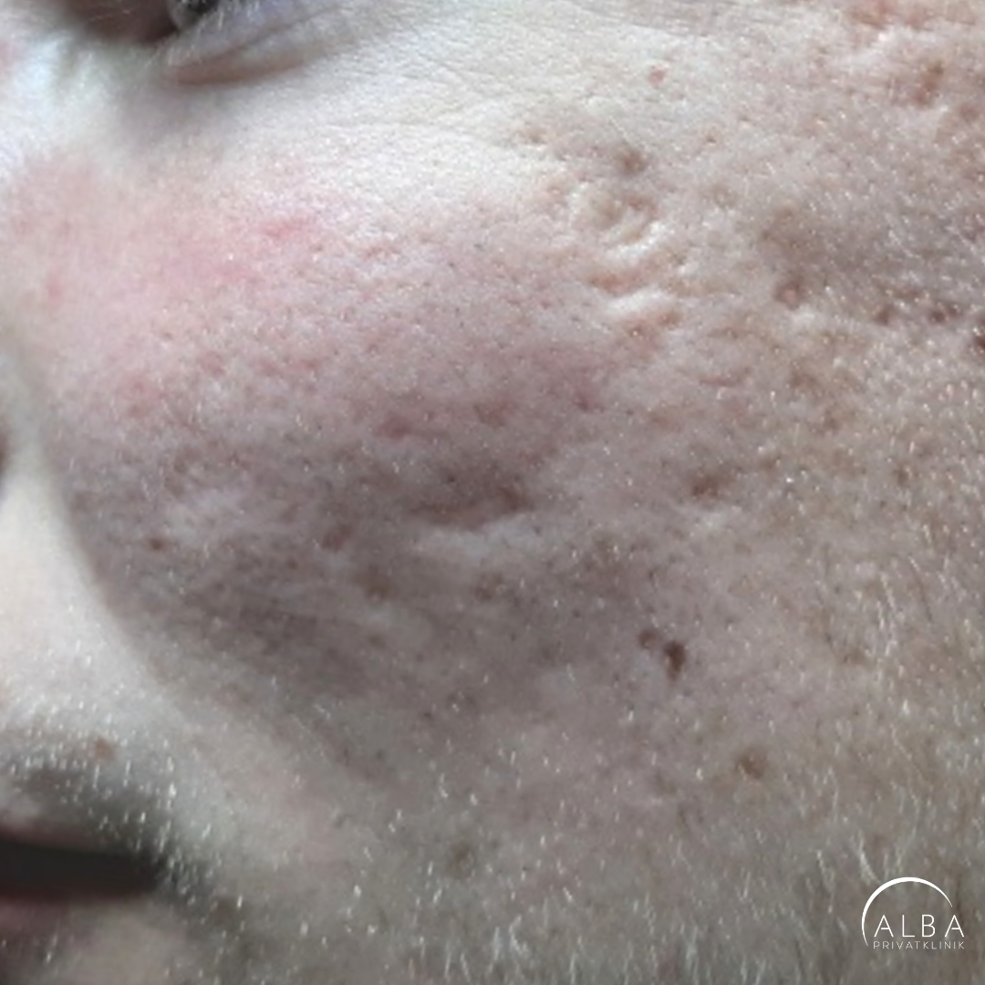 face scars from acne