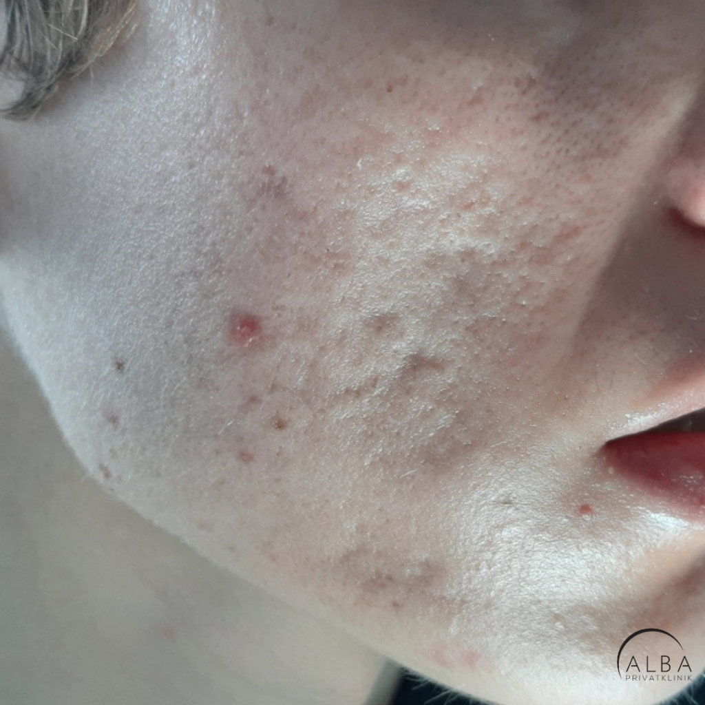 Acne Scar Treatment - Acne Scar Removal - Read more