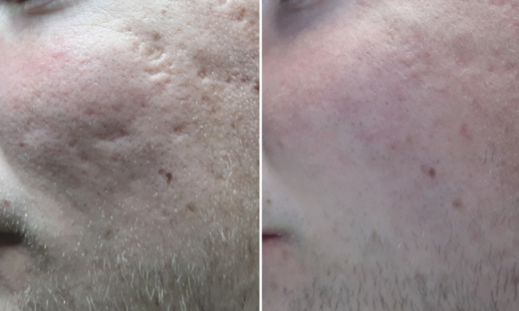 acne scars - before after treatment - dr Knap